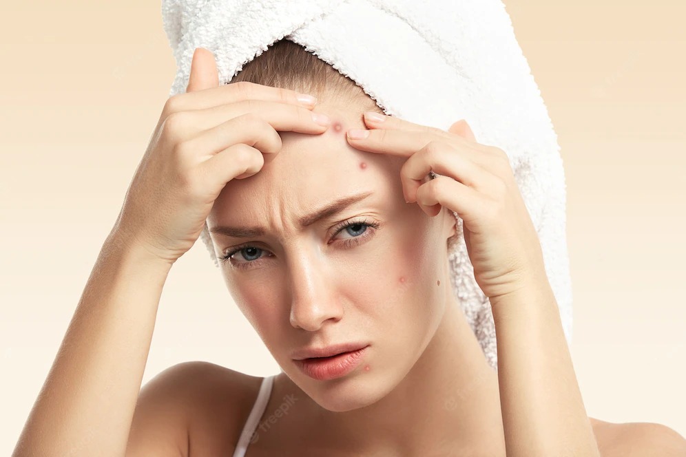 Teenage Acne Causes and Treatment
