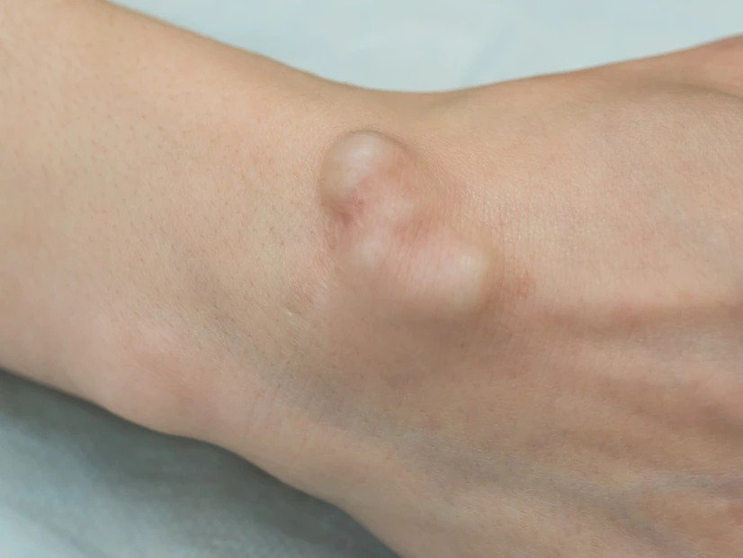 Skin Lump Causes Diagnosis And Treatment